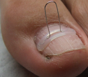 nagelbeugel orthonyxie 